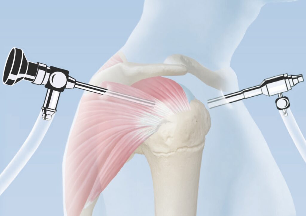 Schulter Arthroskopie GZW