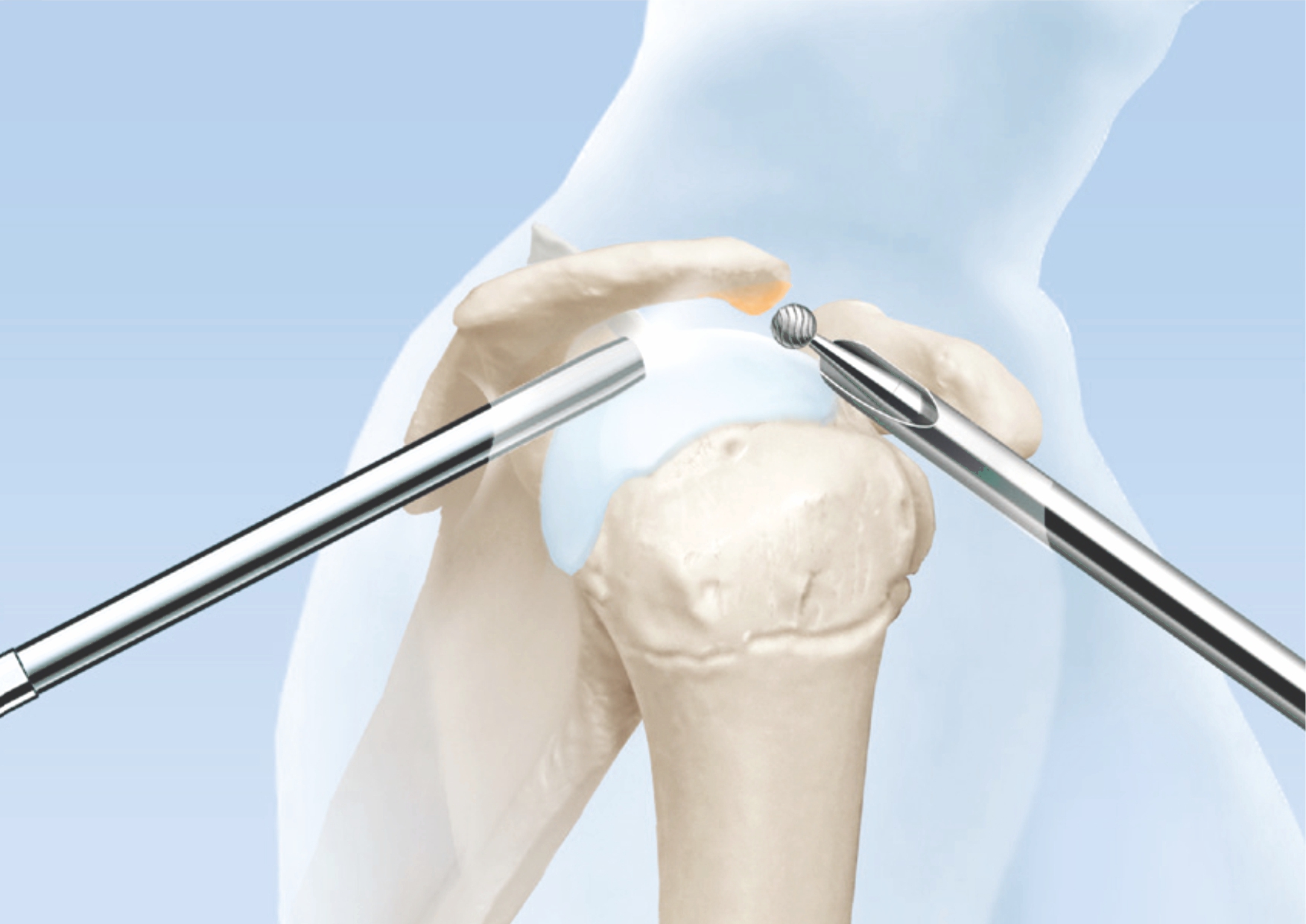 Arthroskopie Schulter Erfahrungsberichte