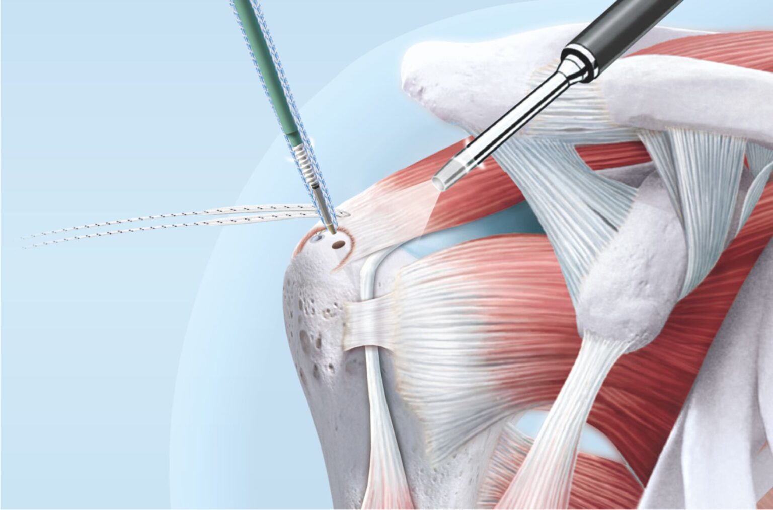 Arthroskopie Schulter Erfahrungsberichte